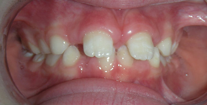 Before treatment for traumatic deep bite which made eating painful